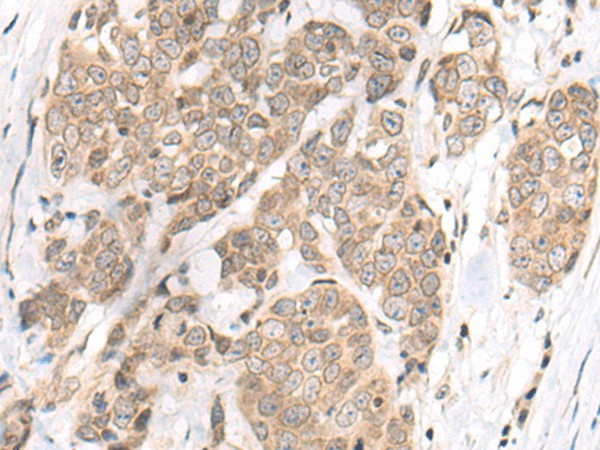 Immunohistochemistry of paraffin-embedded Human thyroid cancer tissue  using M1AP Polyclonal Antibody at dilution of 1:80(?200)