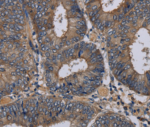 Immunohistochemistry of paraffin-embedded Human colon cancer tissue using NECTIN3 Polyclonal Antibody at dilution 1:40