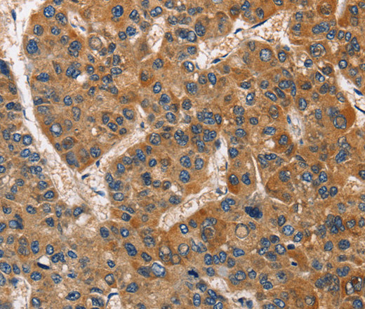 Immunohistochemistry of paraffin-embedded Human liver cancer using BABAM2 Polyclonal Antibody at dilution of 1:40