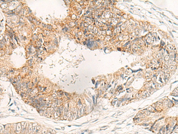 Immunohistochemistry of paraffin-embedded Human colorectal cancer tissue  using ADAMTS2 Polyclonal Antibody at dilution of 1:40(?200)