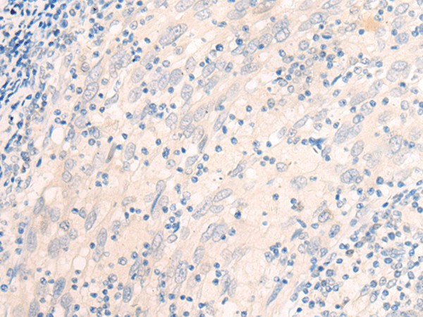 Immunohistochemistry of paraffin-embedded Human cervical cancer tissue  using EME2 Polyclonal Antibody at dilution of 1:40(?200)