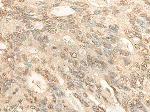 Immunohistochemistry of paraffin-embedded Human colorectal cancer tissue  using BCAS3 Polyclonal Antibody at dilution of 1:35(?200)