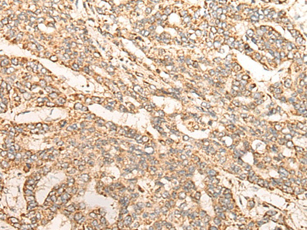 Immunohistochemistry of paraffin-embedded Human liver cancer tissue  using GATD3B Polyclonal Antibody at dilution of 1:35(?200)