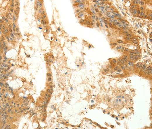 Immunohistochemistry of paraffin-embedded Human colon cancer tissue using RARRES1 Polyclonal Antibody at dilution 1:60