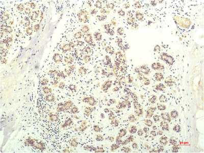 Immunohistochemistry of paraffin-embedded Human breast carcinoma tissue using STAT1 Monoclonal Antibody at dilution of 1:200.