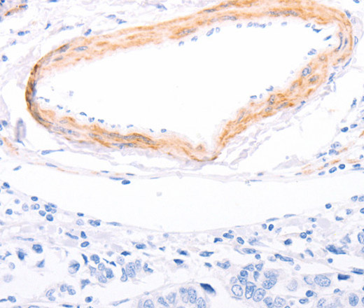 Immunohistochemistry of paraffin-embedded Human breast cancer using TPM1 Polyclonal Antibody at dilution of 1:80