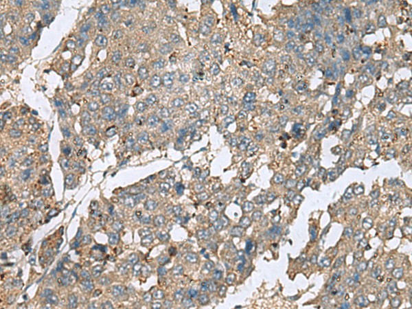 Immunohistochemistry of paraffin-embedded Human liver cancer tissue  using PLA2G2A Polyclonal Antibody at dilution of 1:50(?200)