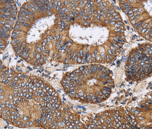 Immunohistochemistry of paraffin-embedded Human colon cancer tissue using PDGFC Polyclonal Antibody at dilution 1:40