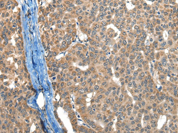 Immunohistochemistry of paraffin-embedded Human liver cancer tissue  using BOLA1 Polyclonal Antibody at dilution of 1:50(?200)