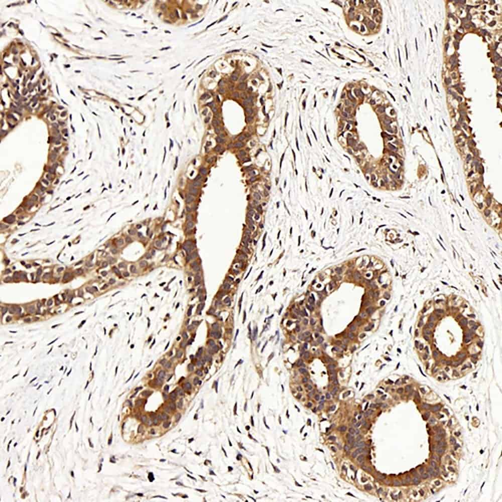 Immunohistochemistry analysis of paraffin-embedded human breast  using CDK4 Polyclonal Antibody at dilution of 1:100.