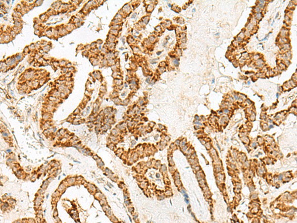 Immunohistochemistry of paraffin-embedded Human thyroid cancer tissue  using NUP210 Polyclonal Antibody at dilution of 1:30(?200)