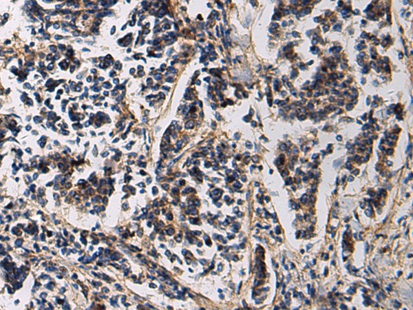 Immunohistochemistry of paraffin-embedded Human breast cancer tissue  using SSH3 Polyclonal Antibody at dilution of 1:60(?200)