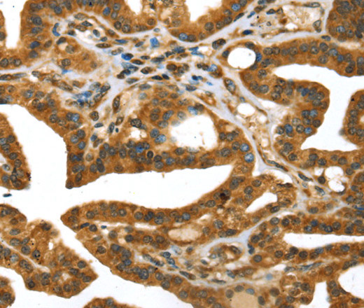 Immunohistochemistry of paraffin-embedded Human thyroid cancer using STX11 Polyclonal Antibody at dilution of 1:30