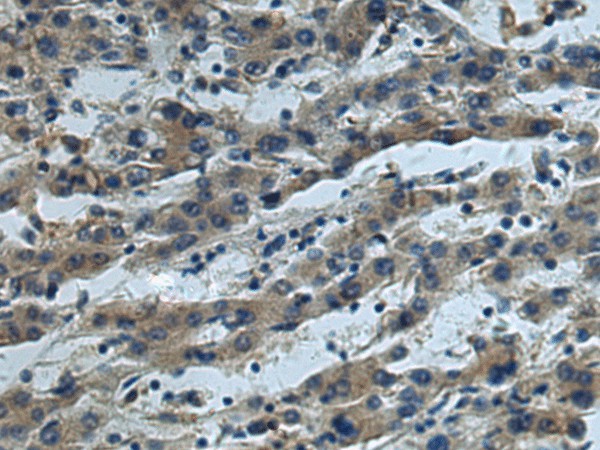 Immunohistochemistry of paraffin-embedded Human liver cancer tissue  using CUL5 Polyclonal Antibody at dilution of 1:55(?200)