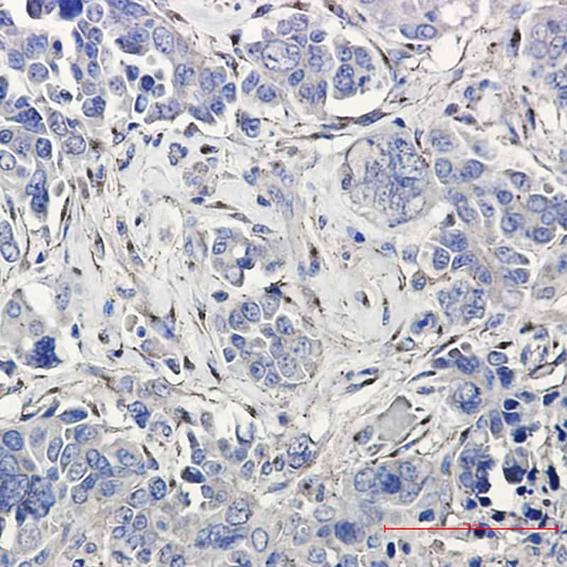 Immunohistochemistry of LRP1 in paraffin-embedded Human Cholangiocarcinoma using LRP1 Rabbit mAb at dilution 1:20