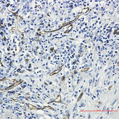 Immunohistochemistry of CD31 in paraffin-embedded Human lung cancer tissue using CD31 Rabbit mAb at dilution 1/50