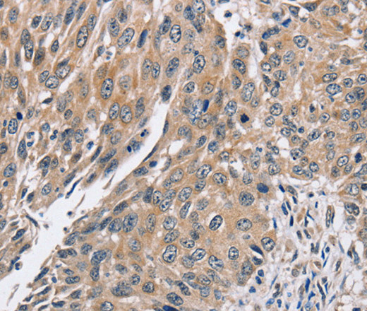 Immunohistochemistry of paraffin-embedded Human lung cancer using PPP1CC Polyclonal Antibody at dilution of 1:40