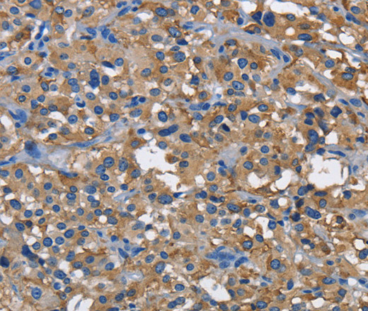 Immunohistochemistry of paraffin-embedded Human thyroid cancer using CD160 Polyclonal Antibody at dilution of 1:60