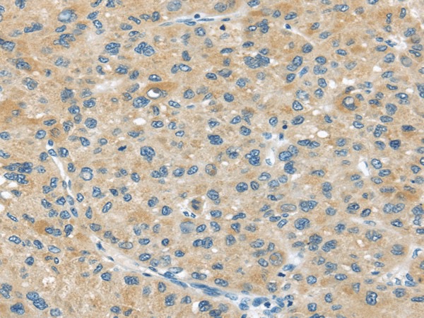 Immunohistochemistry of paraffin-embedded Human liver cancer tissue using ABCC2 Polyclonal Antibody at dilution 1:45