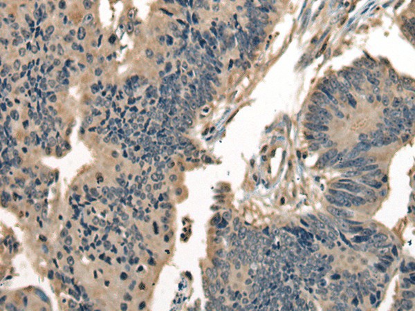 Immunohistochemistry of paraffin-embedded Human colorectal cancer tissue  using DNAJC2 Polyclonal Antibody at dilution of 1:40(?200)