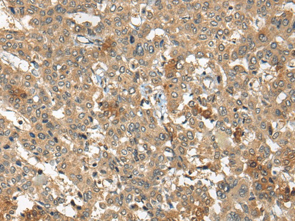 Immunohistochemistry of paraffin-embedded Human liver cancer tissue  using ARCN1 Polyclonal Antibody at dilution of 1:50(?200)