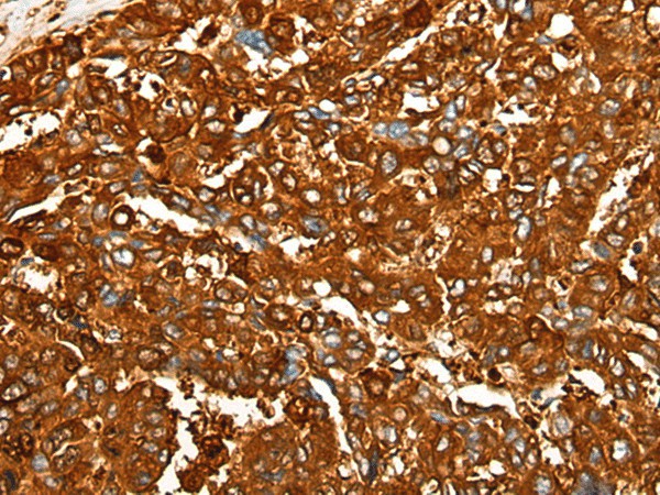 Immunohistochemistry of paraffin-embedded Human liver cancer tissue  using PEAR1 Polyclonal Antibody at dilution of 1:25(?200)