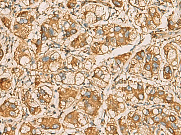 Immunohistochemistry of paraffin-embedded Human liver cancer tissue  using AIMP1 Polyclonal Antibody at dilution of 1:55(?200)