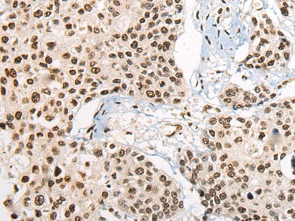 Immunohistochemistry of paraffin-embedded Human prost ate cancer tissue  using RTCB Polyclonal Antibody at dilution of 1:45(?200)