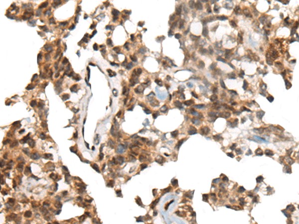 Immunohistochemistry of paraffin-embedded Human ovarian cancer tissue  using CALML5 Polyclonal Antibody at dilution of 1:90(?200)