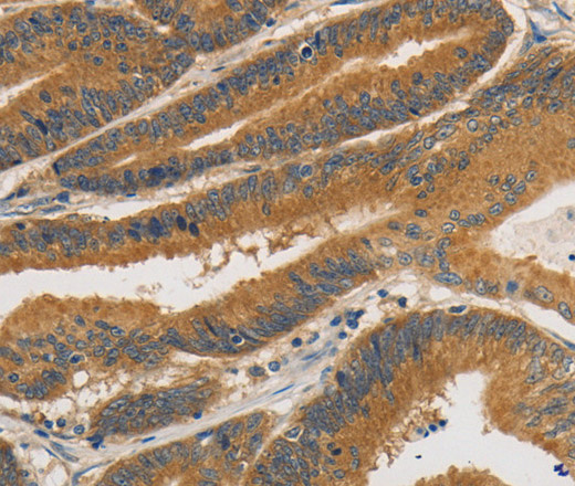 Immunohistochemistry of paraffin-embedded Human colon cancer tissue using PRKD1 Polyclonal Antibody at dilution 1:30