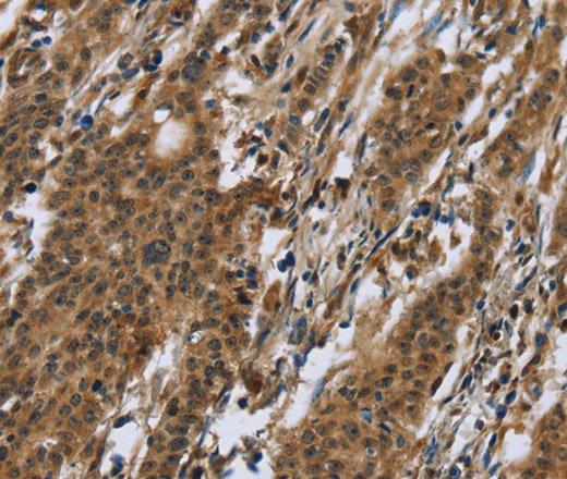 Immunohistochemistry of paraffin-embedded Human gastric cancer using RAP1B Polyclonal Antibody at dilution of 1:50