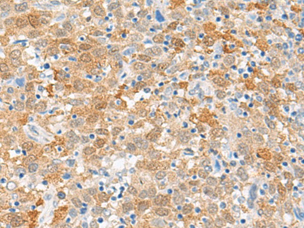 Immunohistochemistry of paraffin-embedded Human cervical cancer tissue  using FANCB Polyclonal Antibody at dilution of 1:60(?200)