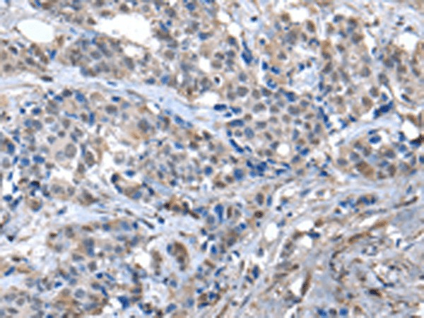 Immunohistochemistry of paraffin-embedded Human breast cancer tissue  using ZFP2 Polyclonal Antibody at dilution of 1:40(?200)