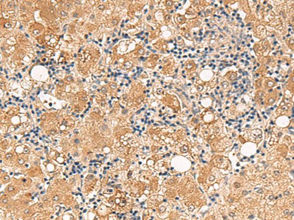 Immunohistochemistry of paraffin-embedded Human liver cancer tissue  using FUNDC2 Polyclonal Antibody at dilution of 1:60(?200)