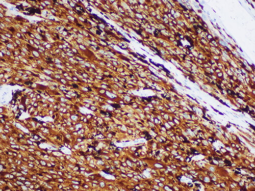 Immunohistochemistry of paraffinembedded Human melanoma tissue with Melan-A Monoclonal Antibody(Antigen repaired by EDTA).