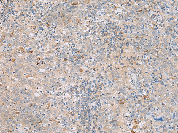 Immunohistochemistry of paraffin-embedded Human cervical cancer tissue  using SAXO2 Polyclonal Antibody at dilution of 1:45(?200)