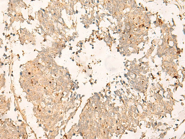 Immunohistochemistry of paraffin-embedded Human lung cancer tissue  using TEX11 Polyclonal Antibody at dilution of 1:30(?200)