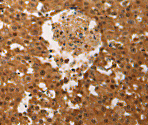 Immunohistochemistry of paraffin-embedded Human ovarian cancer tissue using JUND Polyclonal Antibody at dilution 1:60