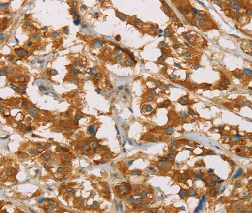 Immunohistochemistry of paraffin-embedded Human thyroid cancer tissue using DLL4 Polyclonal Antibody at dilution 1:50