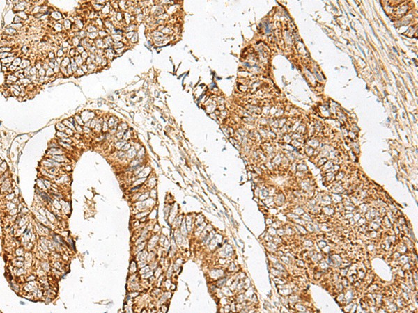 Immunohistochemistry of paraffin-embedded Human colorectal cancer tissue  using GNAT1 Polyclonal Antibody at dilution of 1:25(?200)