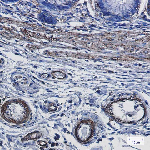 Immunohistochemistry of alpha smooth muscle Actin in paraffin-embedded Human colon cancer tissue using alpha smooth muscle Actin Rabbit mAb at dilution 1:100