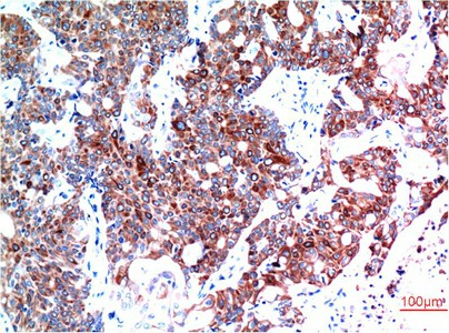 Immunohistochemistry of paraffin-embedded Human breast carcinoma tissue using BECN1 Monoclonal Antibody at dilution of 1:200.