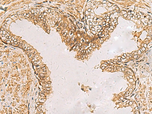 Immunohistochemistry of paraffin-embedded Human prost ate cancer tissue  using RAB38 Polyclonal Antibody at dilution of 1:60(?200)