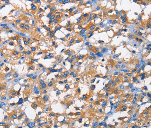 Immunohistochemistry of paraffin-embedded Human thyroid cancer tissue using PFKP Polyclonal Antibody at dilution 1:50