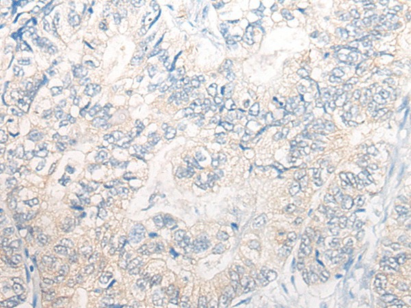 Immunohistochemistry of paraffin-embedded Human gastric cancer tissue  using PNPO Polyclonal Antibody at dilution of 1:30(?200)