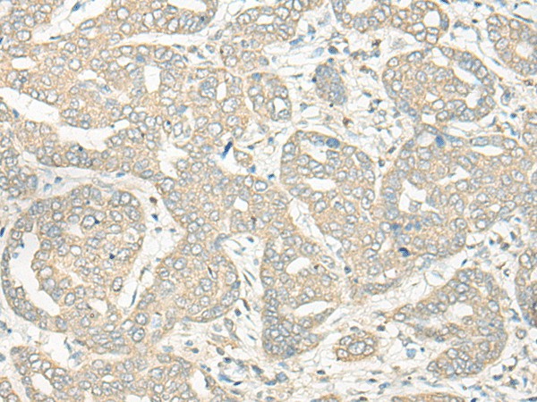 Immunohistochemistry of paraffin-embedded Human liver cancer tissue  using HLA-DRB5 Polyclonal Antibody at dilution of 1:45(?200)