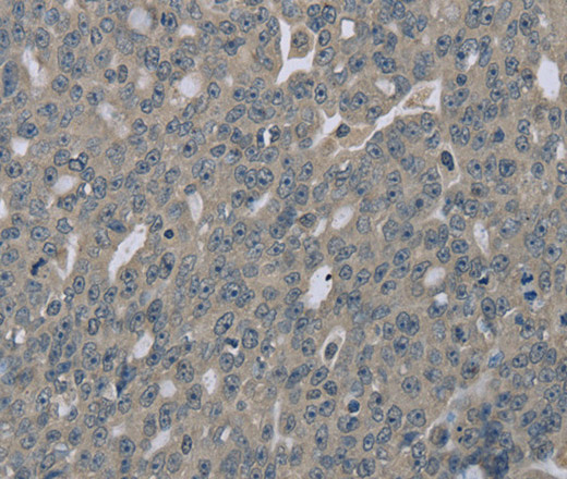 Immunohistochemistry of paraffin-embedded Human ovarian cancer tissue using EDN1 Polyclonal Antibody at dilution 1:30