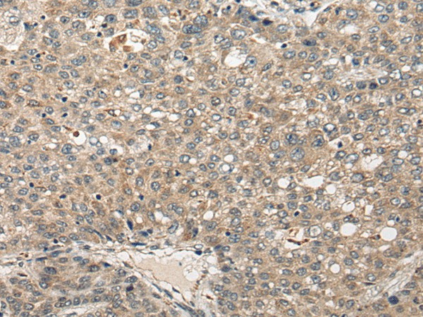 Immunohistochemistry of paraffin-embedded Human liver cancer tissue  using FUT4 Polyclonal Antibody at dilution of 1:40(?200)