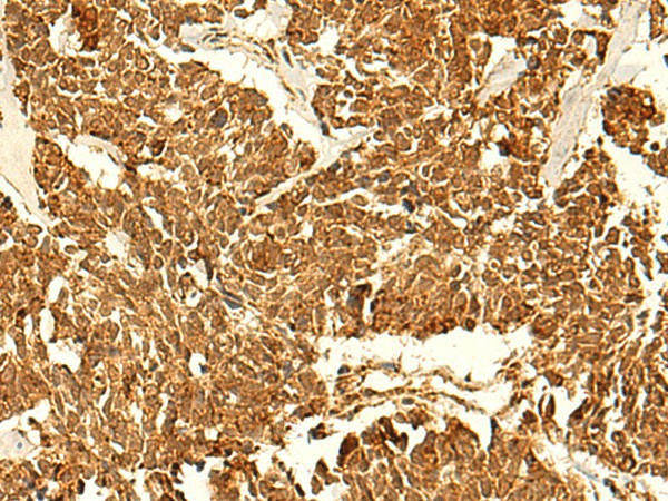 Immunohistochemistry of paraffin-embedded Human lung cancer tissue  using ABHD10 Polyclonal Antibody at dilution of 1:50(?200)