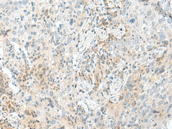 Immunohistochemistry of paraffin-embedded Human cervical cancer tissue  using ENSA Polyclonal Antibody at dilution of 1:70(?200)